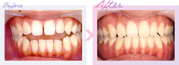 インビザラインの症例 Before After