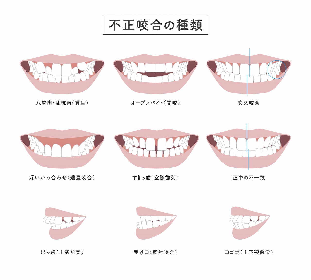 幅広い歯並びに対応できる