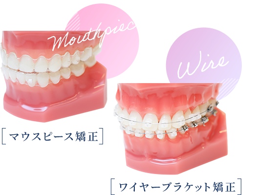 マウスピース矯正 ワイヤーブラケット矯正