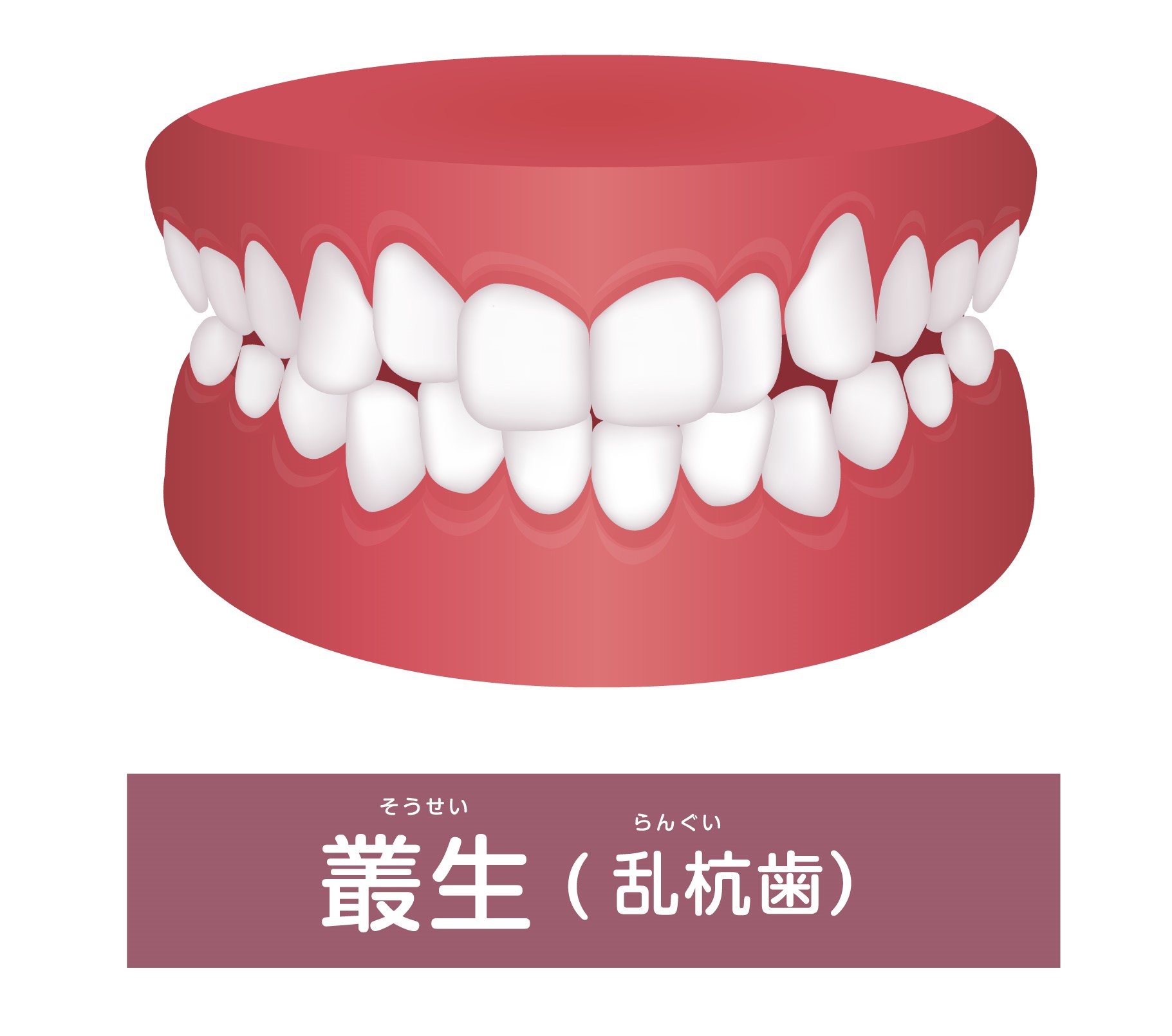 叢生（八重歯・がちゃ歯）