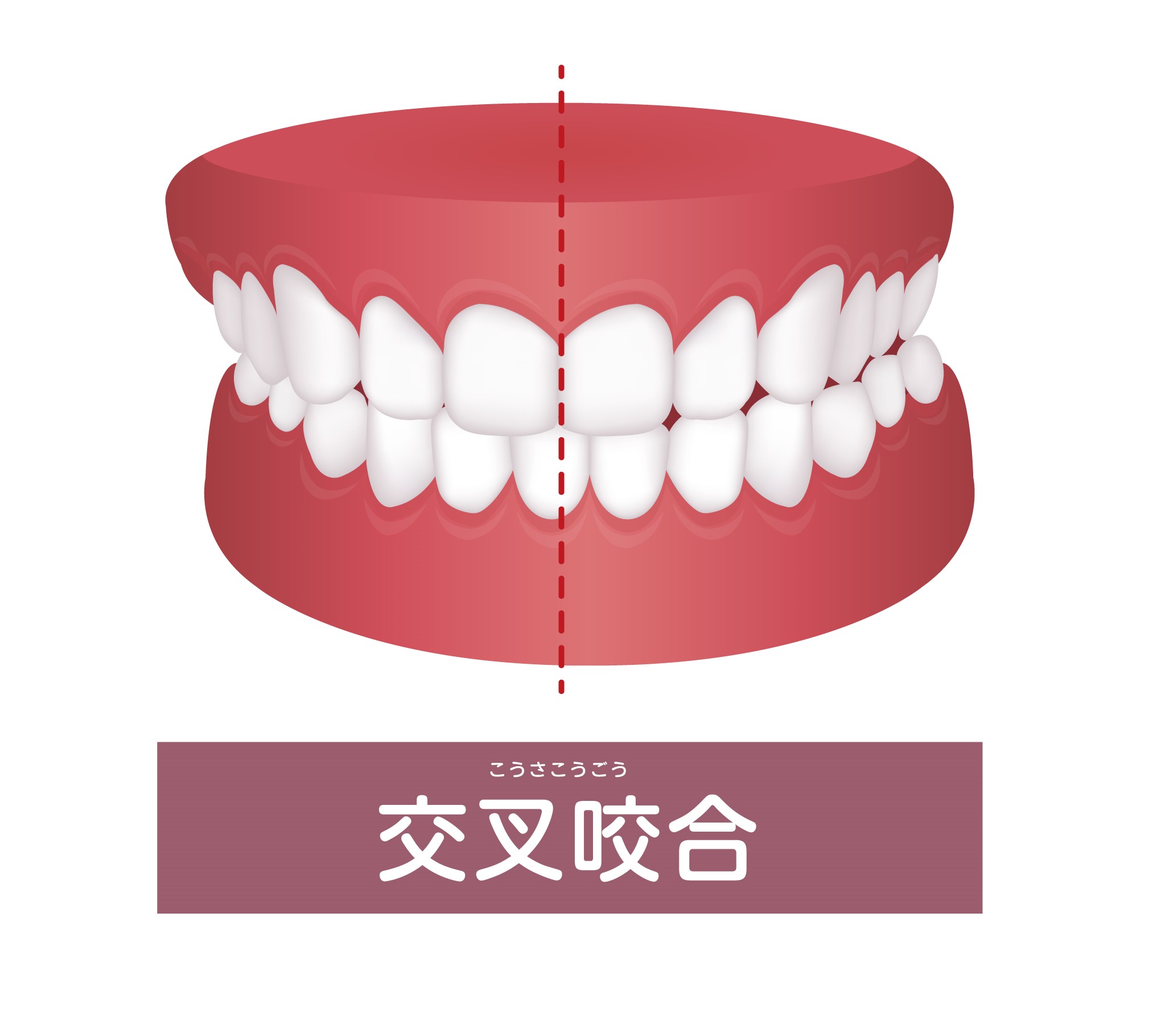 交叉咬合（噛み合わせが反対になっている）