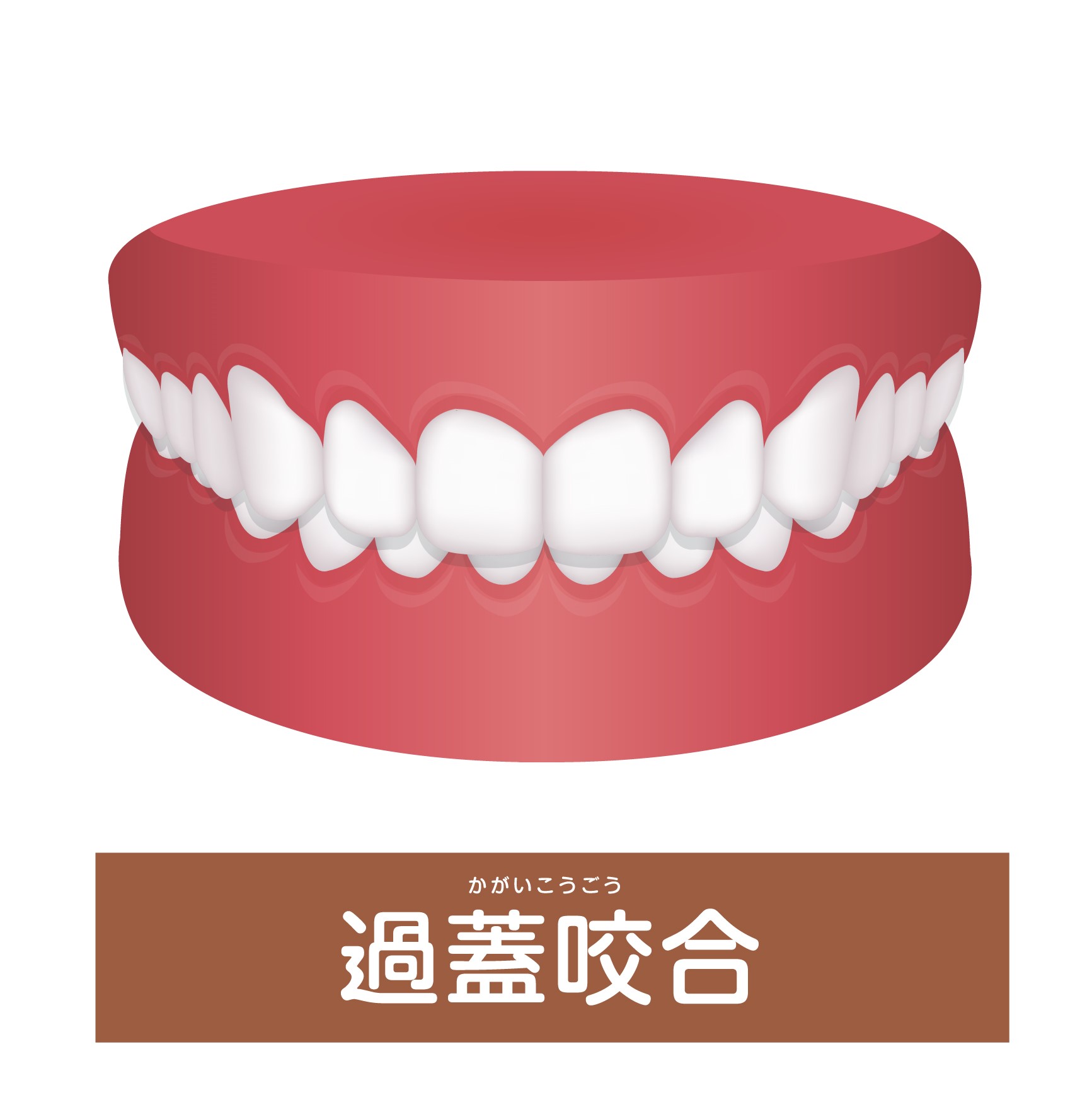 過蓋咬合（噛み合わせが深い）